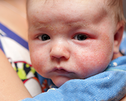 Baby eczema image 